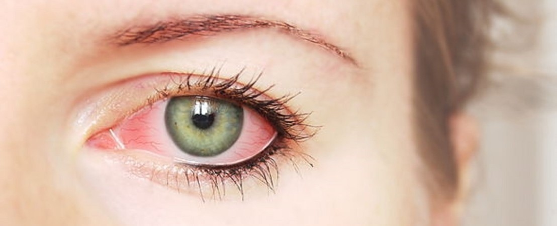 التهاب ملتحمة العين.. الأعراض والعلاج